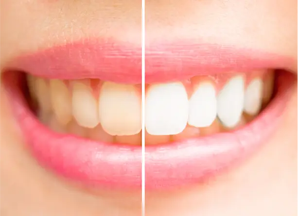 half teeth